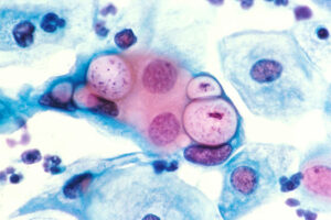 800px Pap smear showing clamydia in the vacuoles 500x HE