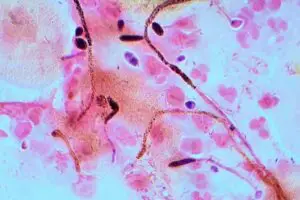 Candida Gram stain 300x200 1