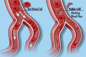 Sickle Cell Disease 27249799083 1 300x200 1